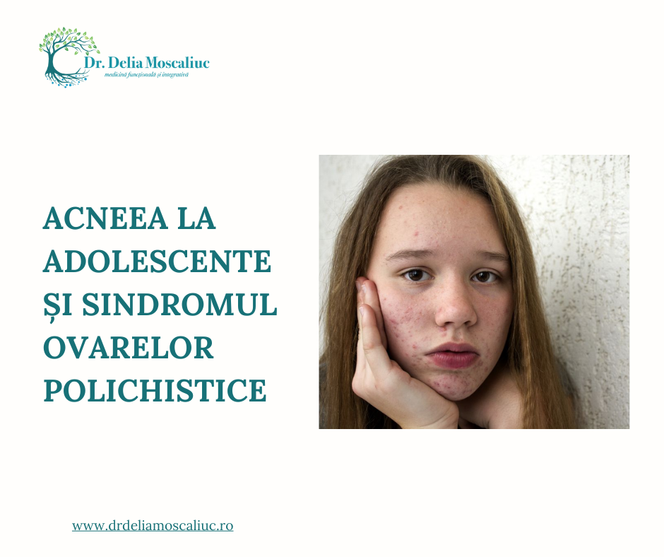 Acneea la adolescente